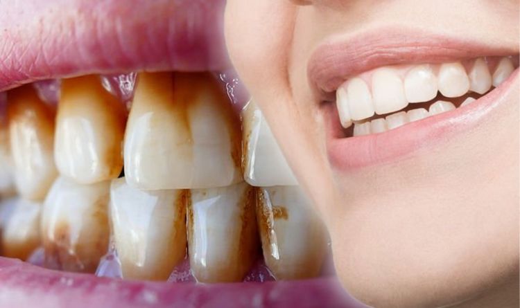 How to remove brown stains from teeth True Hollywood Talk
