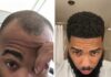 Rapper Nick LaVelle’s hair restoration journey began at the Bubolo Clinic in Atlanta, Georgia Rapper Nick LaVelle