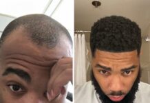 Rapper Nick LaVelle’s hair restoration journey began at the Bubolo Clinic in Atlanta, Georgia Rapper Nick LaVelle