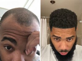 Rapper Nick LaVelle’s hair restoration journey began at the Bubolo Clinic in Atlanta, Georgia Rapper Nick LaVelle