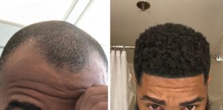 Rapper Nick LaVelle’s hair restoration journey began at the Bubolo Clinic in Atlanta, Georgia Rapper Nick LaVelle