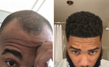 Rapper Nick LaVelle’s hair restoration journey began at the Bubolo Clinic in Atlanta, Georgia Rapper Nick LaVelle