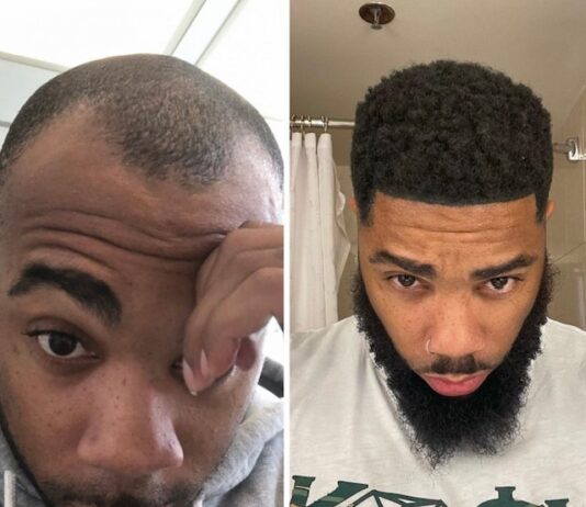 Rapper Nick LaVelle’s hair restoration journey began at the Bubolo Clinic in Atlanta, Georgia Rapper Nick LaVelle