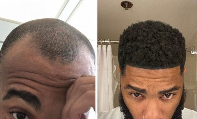 Rapper Nick LaVelle’s hair restoration journey began at the Bubolo Clinic in Atlanta, Georgia Rapper Nick LaVelle