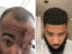 Rapper Nick LaVelle’s hair restoration journey began at the Bubolo Clinic in Atlanta, Georgia Rapper Nick LaVelle